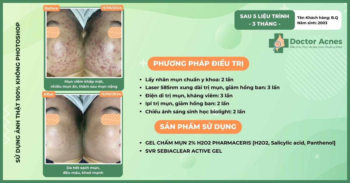 ca lâm sàng trị mụn