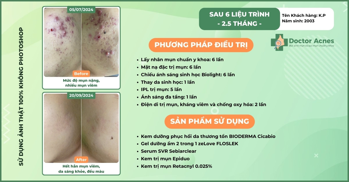 ca lâm sàng trị mụn