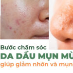 8 bước chăm sóc da dầu mụn mùa hè giúp giảm nhờn và mụn