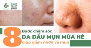 các bước chăm sóc da dầu mụn mùa hè