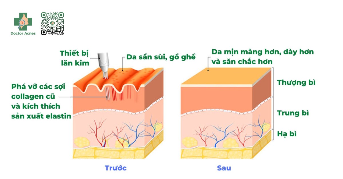 cơ chế của lăn kim trị sẹo rỗ