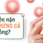 Có nên nặn mụn trứng cá không?