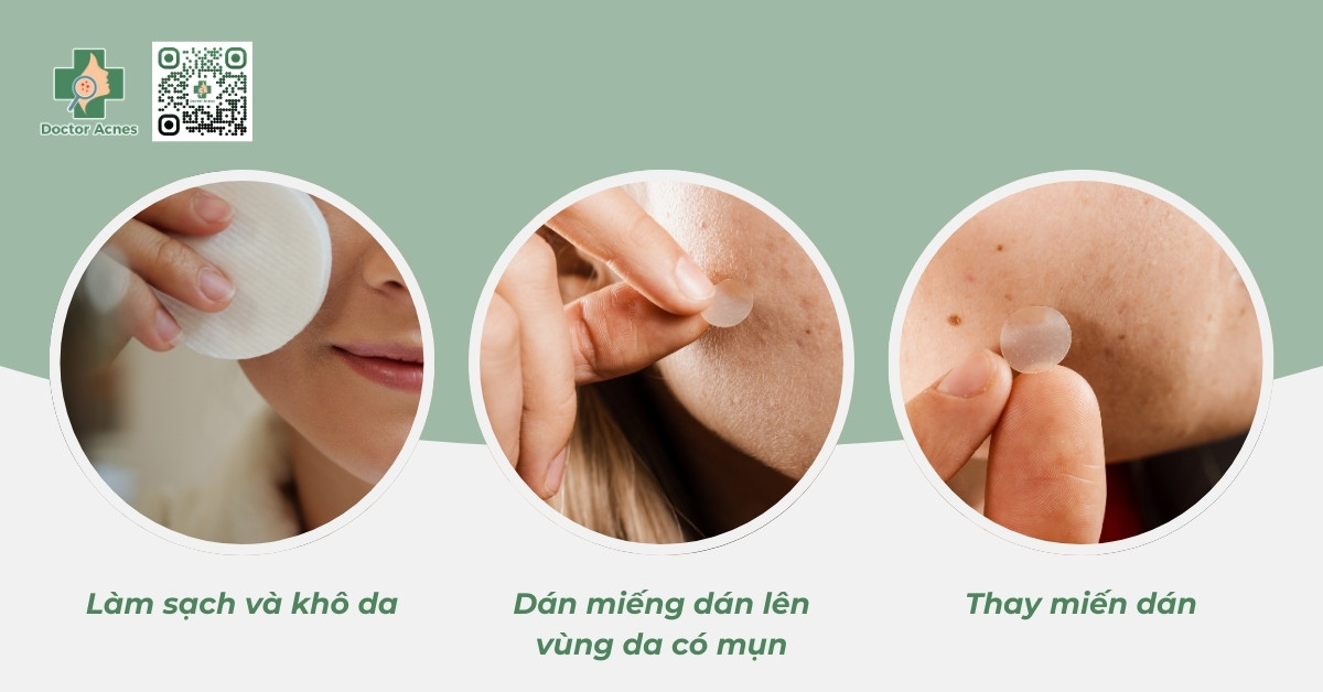 hướng dẫn sử dụng miếng dán trị mụn