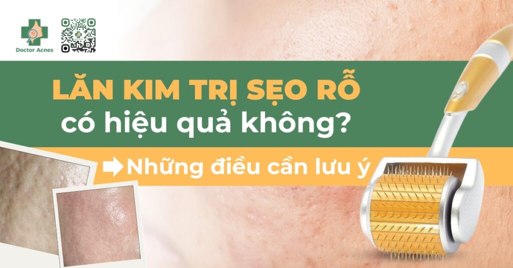 lăn kim trị sẹo rỗ có hiệu quả không