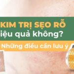 Lăn kim trị sẹo rỗ có hiệu quả không? Những điều cần lưu ý