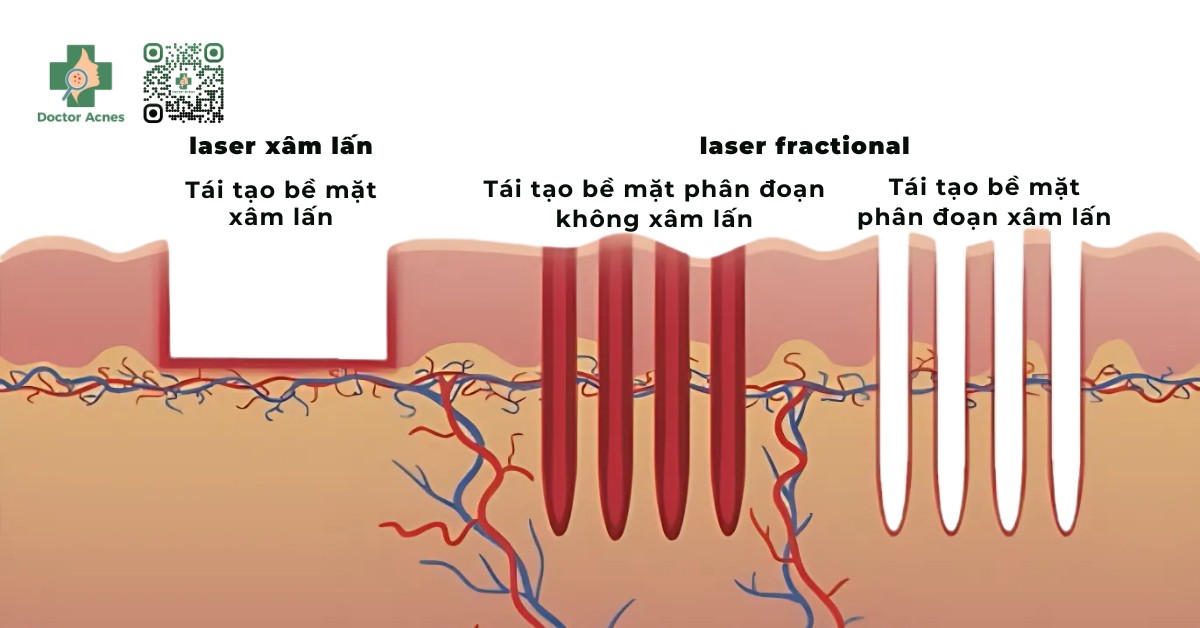 laser fractional là gì