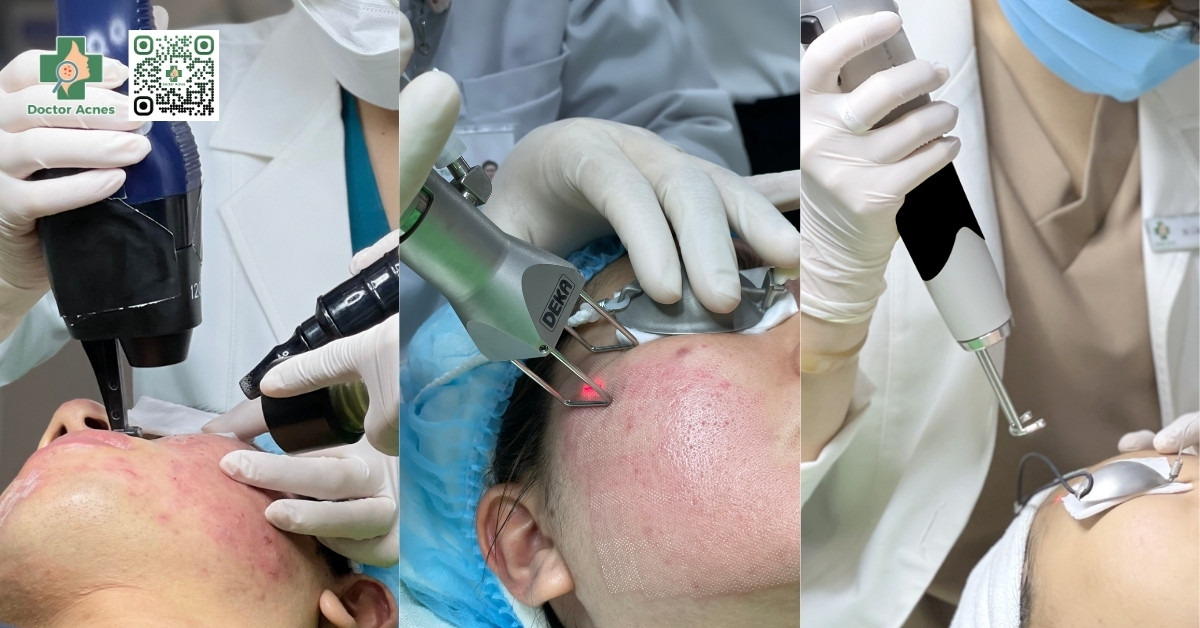 laser fractional trị sẹo