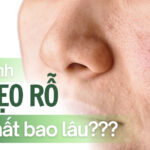Liệu trình trị sẹo rỗ mất bao lâu? 4 yếu tố ảnh hưởng thời gian điều trị