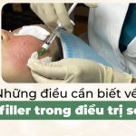 Những điều cần biết về tiêm filler trong điều trị sẹo rỗ (lõm)