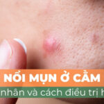 Nổi mụn ở cằm: nguyên nhân và cách điều trị hiệu quả