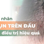 Nguyên nhân nổi mụn trên đầu và cách điều trị hiệu quả