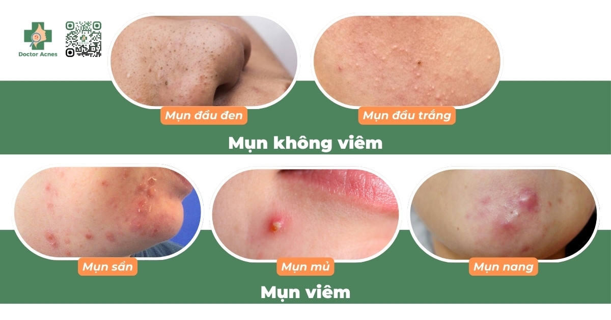 phân loại mụn trứng cá