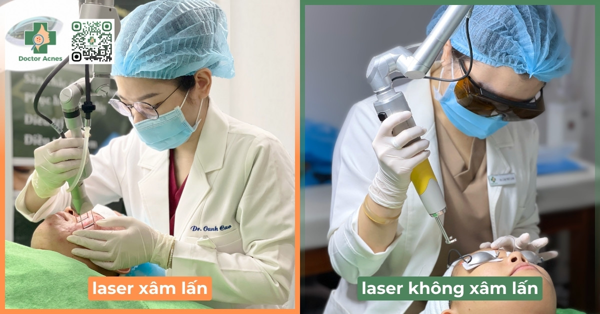 phương pháp laser trị sẹo lồi