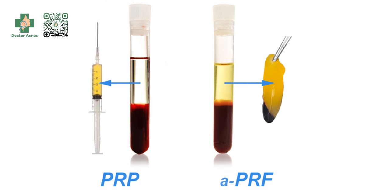 prp và prf