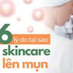Giải đáp 6 lý do tại sao càng skincare càng lên mụn
