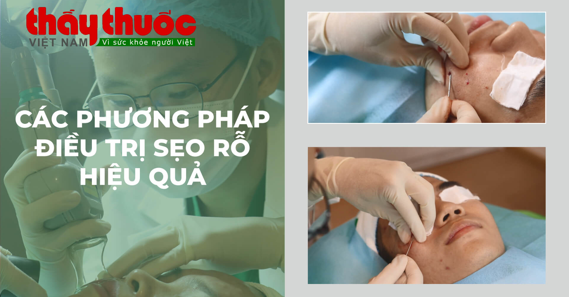 thaythuocvietnam các phương pháp điều trị sẹo rỗ