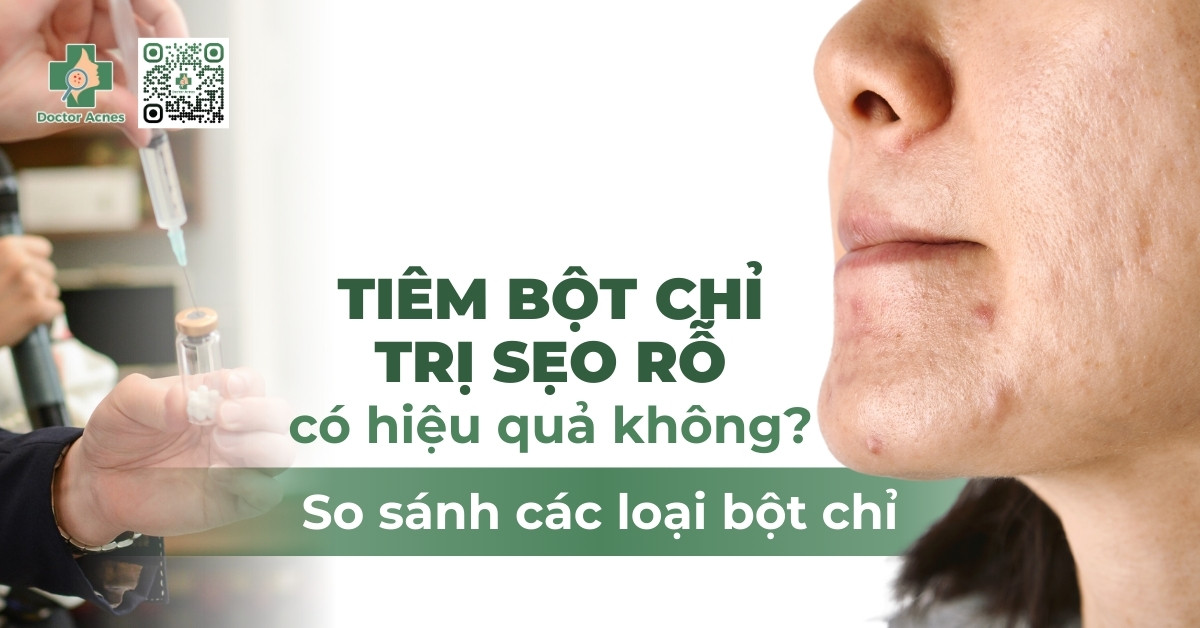 tiêm bột chỉ trị sẹo