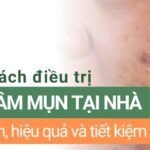 10 cách điều trị thâm mụn tại nhà đơn giản, hiệu quả và tiết kiệm