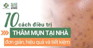 trị thâm mụn tại nhà