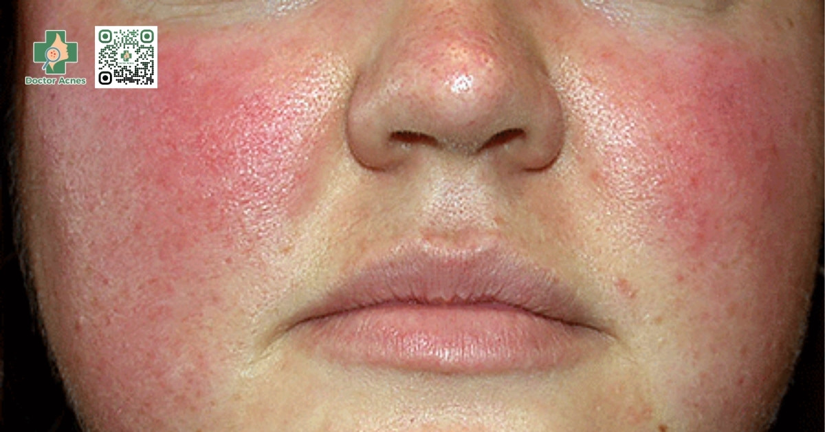 trứng cá đỏ rosacea