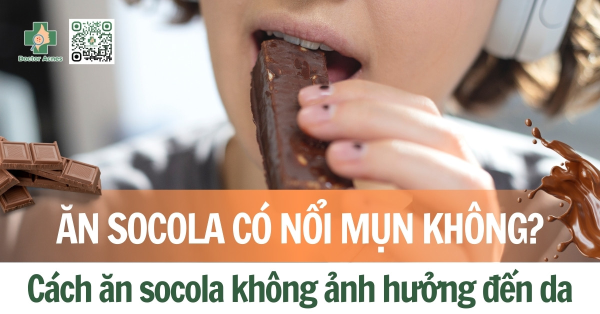 ăn socola có nổi mụn không