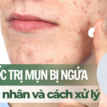 Bôi thuốc trị mụn bị ngứa: nguyên nhân và cách xử lý
