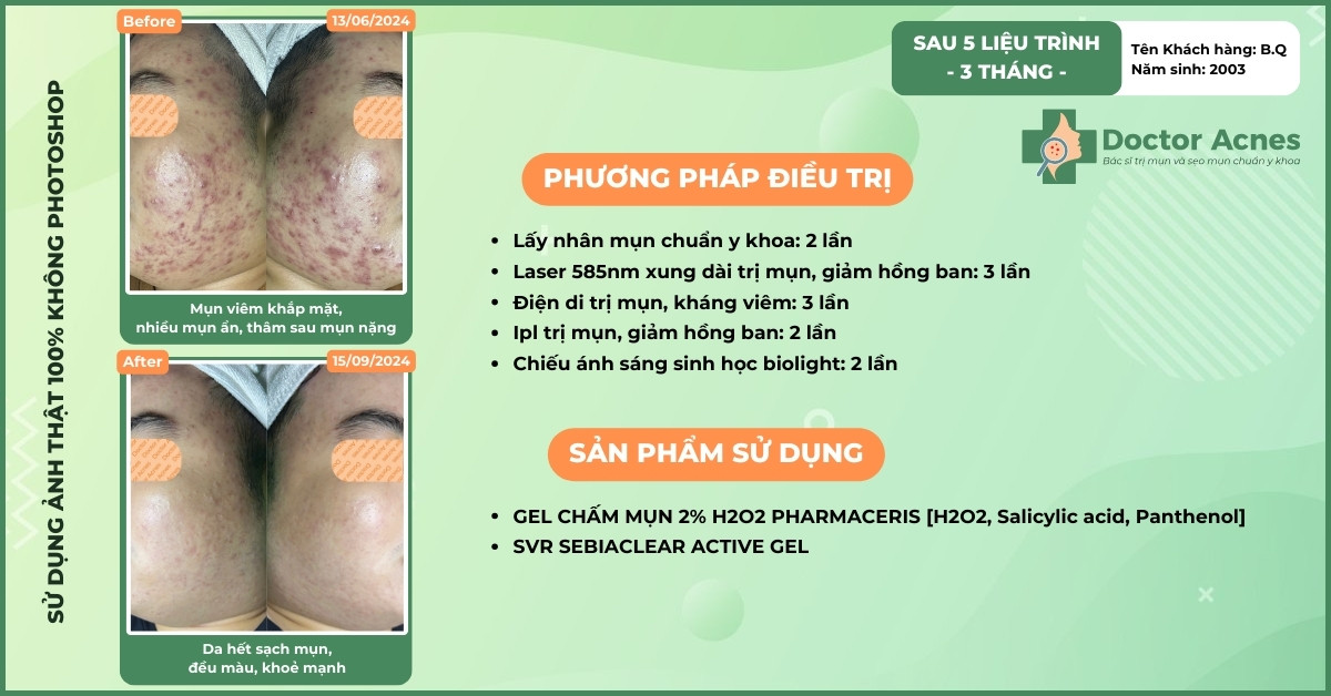 ca lâm sàng trị mụn