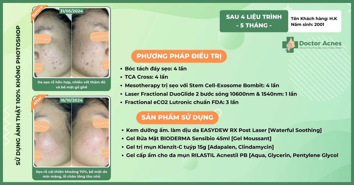 ca lâm sàng trị sẹo