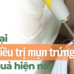 Các loại laser điều trị mụn trứng cá hiệu quả hiện nay