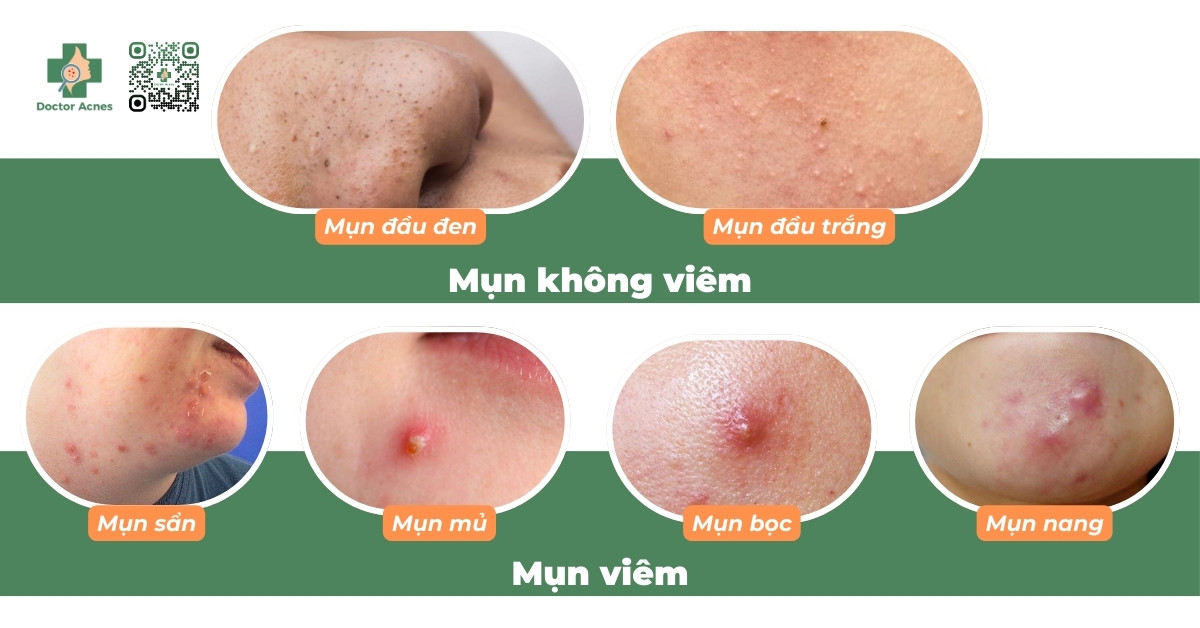 các loại mụn thường gặp khi uống kháng sinh