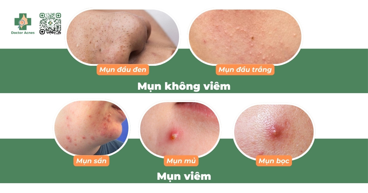 các loại mụn thường gặp ở ngực