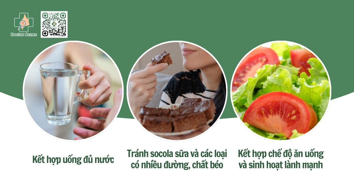 cách ăn socola không nổi mụn