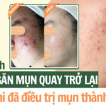 4 cách ngăn mụn quay trở lại sau khi đã điều trị mụn thành công