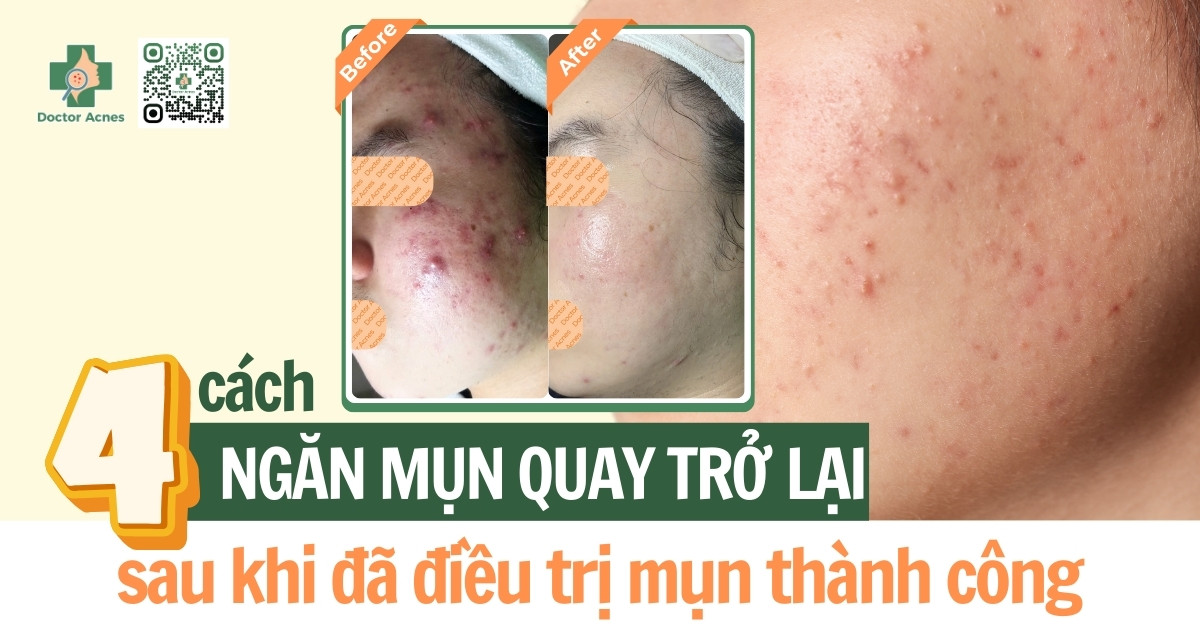 cách ngăn mụn quay trở lại