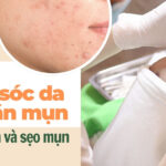 Bí quyết chăm sóc da sau nặn mụn ngừa thâm và sẹo mụn