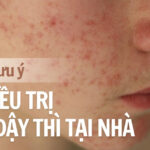 Những lưu ý quan trọng khi điều trị mụn dậy thì tại nhà