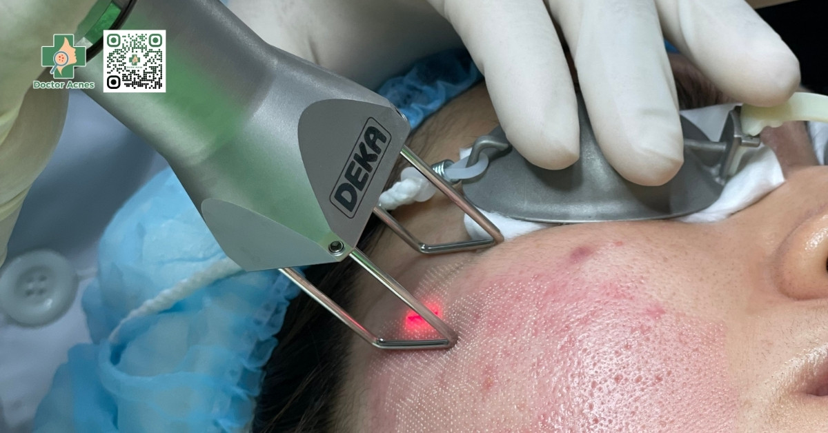 laser deka duoglide trị sẹo