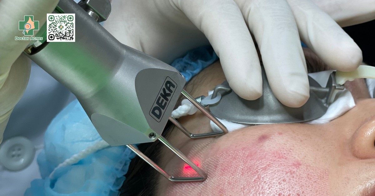 laser fractional deka 2 bước sóng trị sẹo lồi