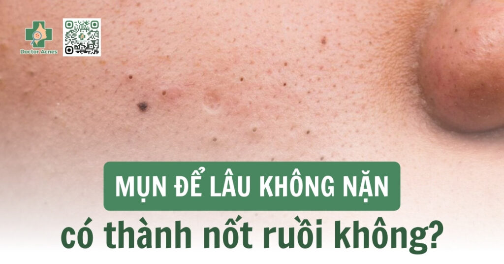 mụn có thành nốt ruồi không