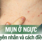 Mụn ở ngực: nguyên nhân do đâu và cách điều trị