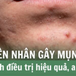 Nguyên nhân gây mụn viêm và cách điều trị hiệu quả, an toàn