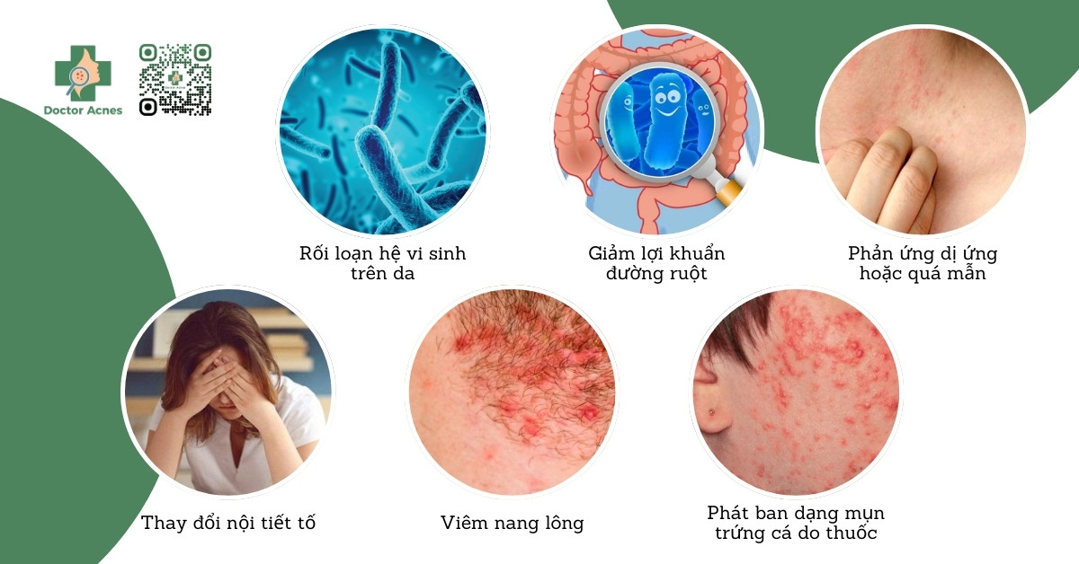 nguyên nhân uống kháng sinh bị nổi mụn