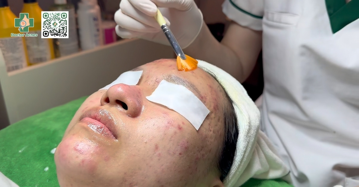 peel da trị mụn đầu đen