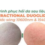 Quá trình phục hồi da sau liệu trình Deka DUOGlide