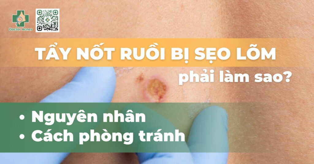 tẩy nốt ruồi bị sẹo lõm phải làm sao