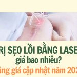 Trị sẹo lồi bằng laser giá bao nhiêu? Bảng giá cập nhật năm 2025