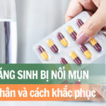 Uống kháng sinh bị nổi mụn: nguyên nhân và cách khắc phục