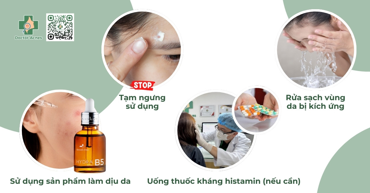 xử lí khi bị kích ứng thuốc trị mụn