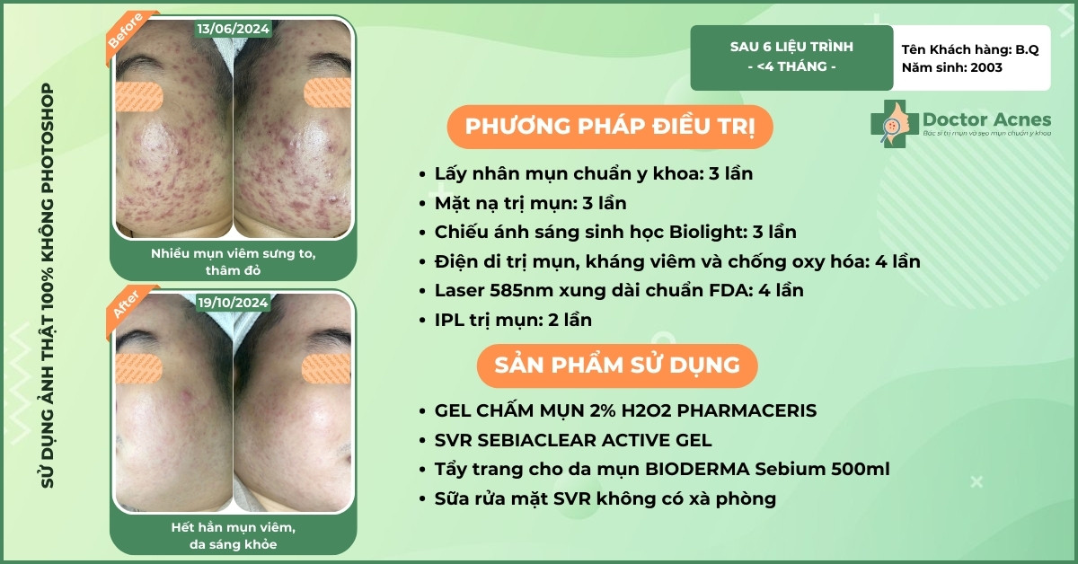 ca lâm sàng trị mụn