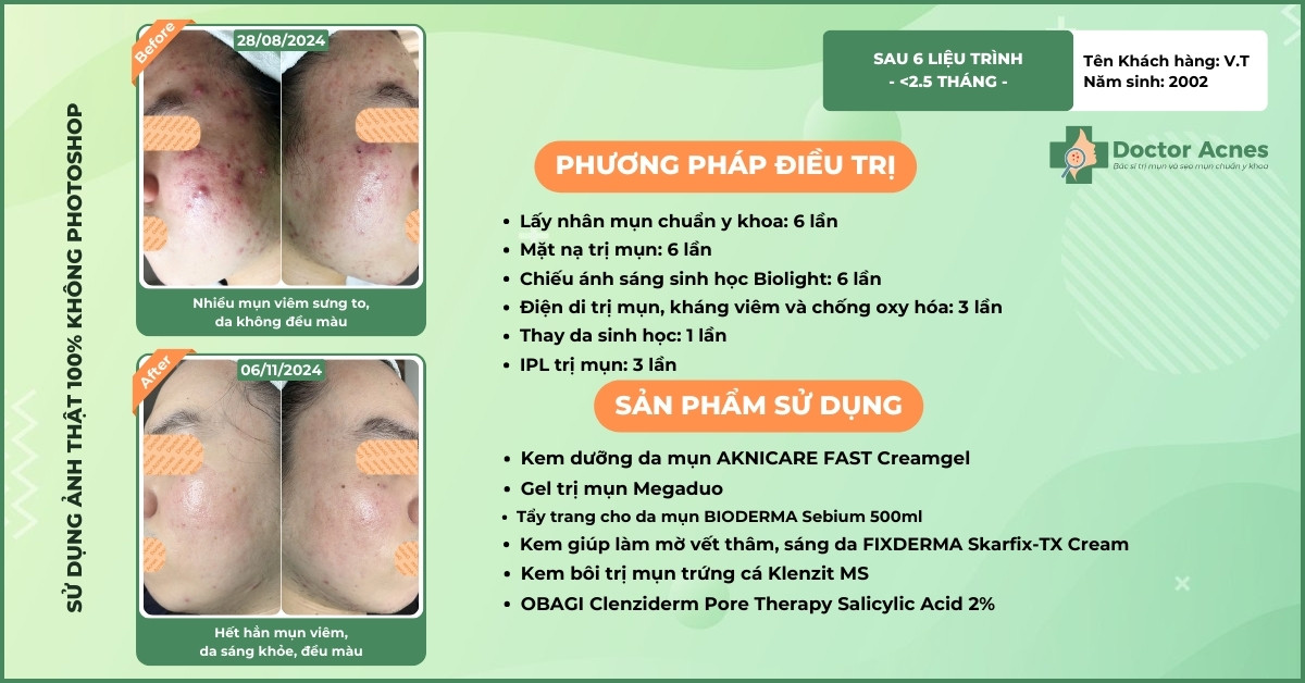 ca lâm sàng trị mụn